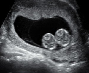 Ultrasound of momo twins pregnancy at 7 weeks gestation